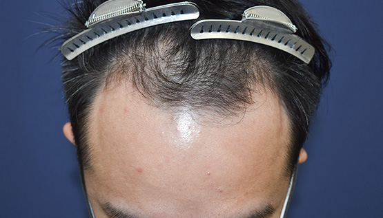 30代 男性 K.T.さん 生え際・頭頂部・つむじ 自毛植毛(MIRAI法)3,000株の症例|自毛植毛の症例(手術前)