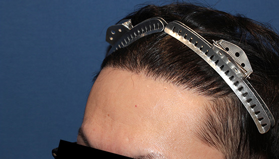 30代 男性 S.K.さん 生え際 前頭部 自毛植毛(MIRAI法)1,700株の症例|自毛植毛の症例(手術後)