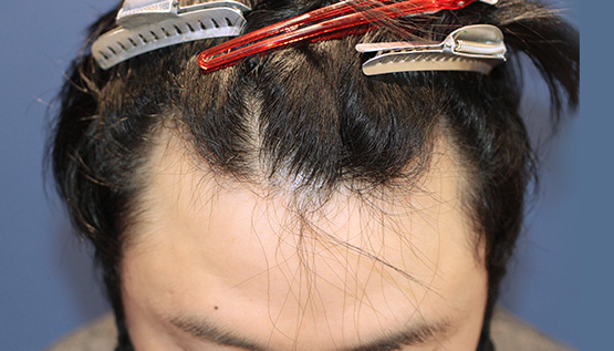 30代 男性 Y.Y.さん 生え際・つむじ 自毛植毛(MIRAI法)1,000株の症例|自毛植毛の症例(手術前)