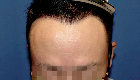 40代 男性 K.S.さん 生え際 自毛植毛(MIRAI法)1,500株の症例|自毛植毛の症例(手術後)