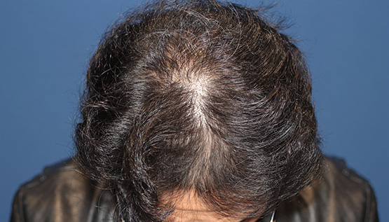 40代 男性 N.T.さん 生え際・前頭部・頭頂部 自毛植毛(MIRAI法)3,000株の症例|自毛植毛の症例(2回目手術後)