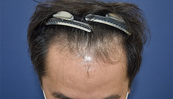 40代 男性 H.S.さん 生え際 自毛植毛(MIRAI法)1,600株の症例|自毛植毛の症例(手術前)