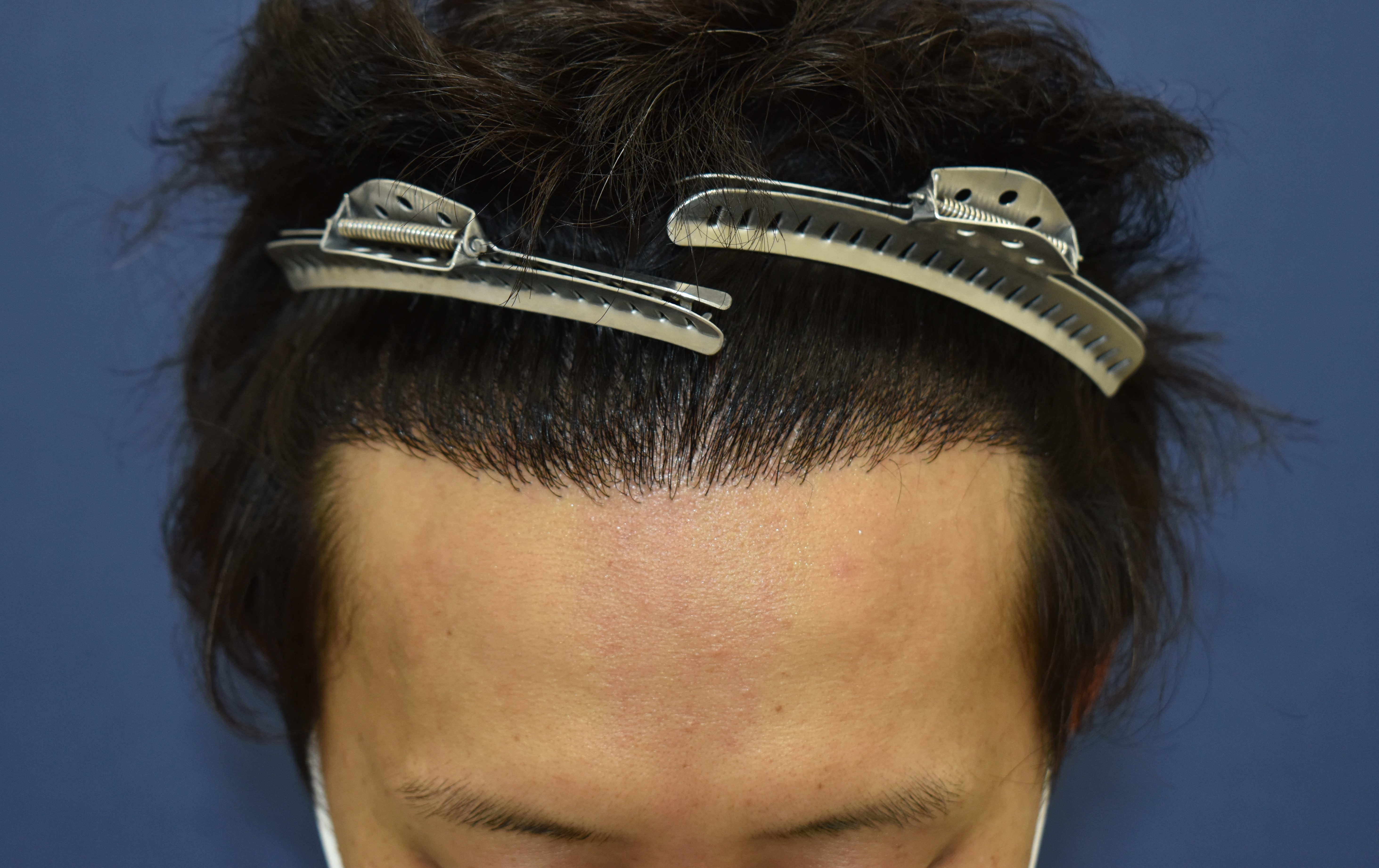 30代 男性 K.N.さん 生え際 自毛植毛(MIRAI法)2,700株の症例|自毛植毛の症例(手術後)