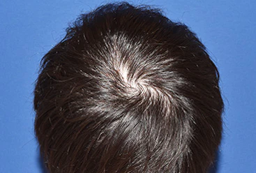 30代 男性 W.Y.さん 前頭部・頭頂部 自毛植毛(MIRAI法)2,700株の症例|自毛植毛の症例(手術後)