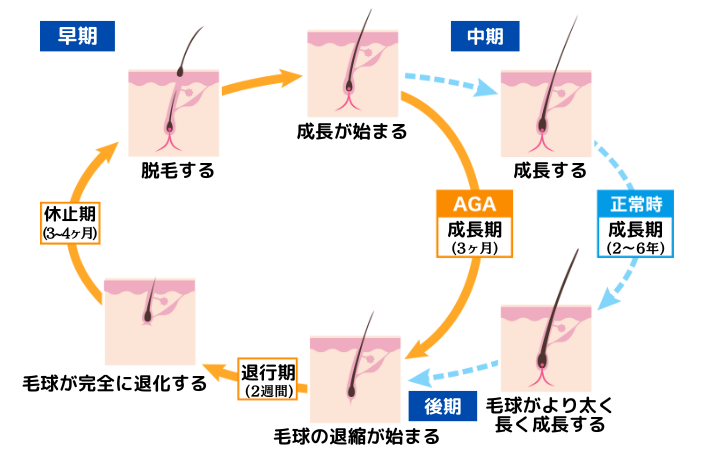 AGAのメカニズム
