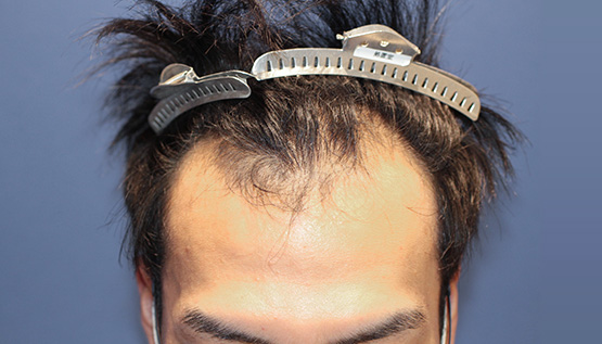 20代 男性 Y.B.さん 生え際・前頭部・頭頂部(MIRAI法)3,000株の症例|自毛植毛の症例(手術前)