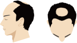 2000株(グラフト)以上の自毛植毛の場合