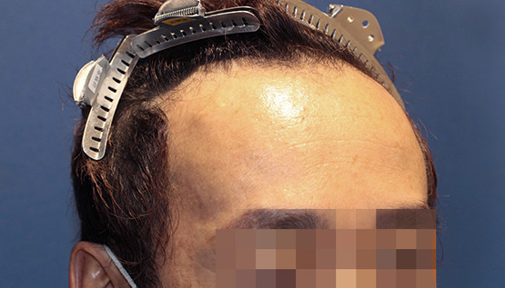 40代 男性 Y.N.さん 生え際 自毛植毛(MIRAI法)1,600株の症例|自毛植毛の症例(手術前)