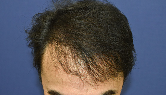 50代 男性 Y.S.さん 生え際 前頭部 自毛植毛(MIRAI法)2,400株の症例|自毛植毛の症例(手術後)
