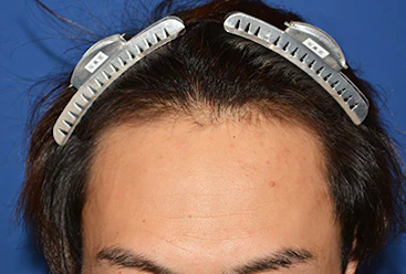 30代 男性 H.T.さん 生え際 自毛植毛(MIRAI法)1,500株の症例|自毛植毛の症例(手術前)