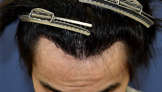 20代 男性 T.T.さん 生え際 自毛植毛(MIRAI法)1,500株の症例|自毛植毛の症例(手術後)