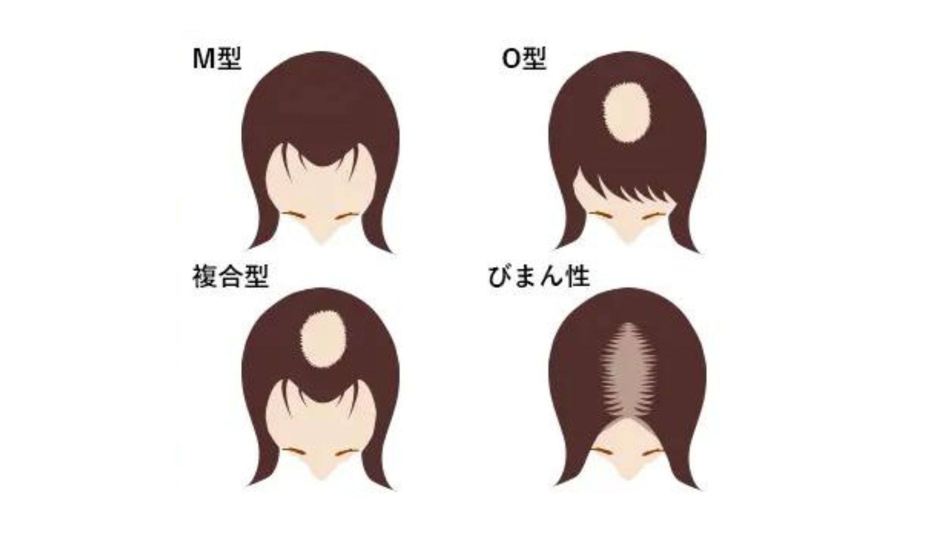 女性の抜け毛の特徴