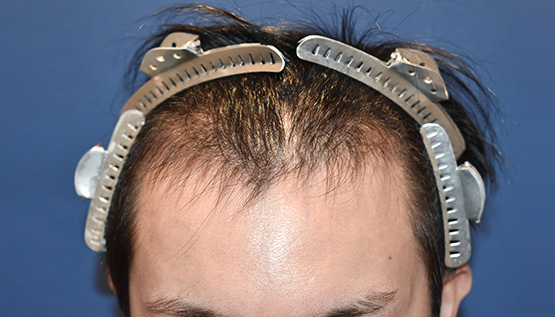 20代 男性 Y.R.さん 生え際 自毛植毛(MIRAI法)1,800株の症例|自毛植毛の症例(手術前)