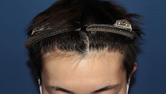 20代 男性 K.S.さん 生え際 自毛植毛(MIRAI法)800株の症例|自毛植毛の症例(手術後)