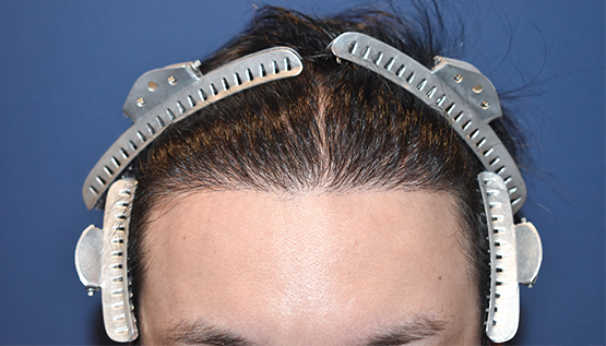 20代 男性 Y.R.さん 生え際 自毛植毛(MIRAI法)1,800株の症例|自毛植毛の症例(手術後)