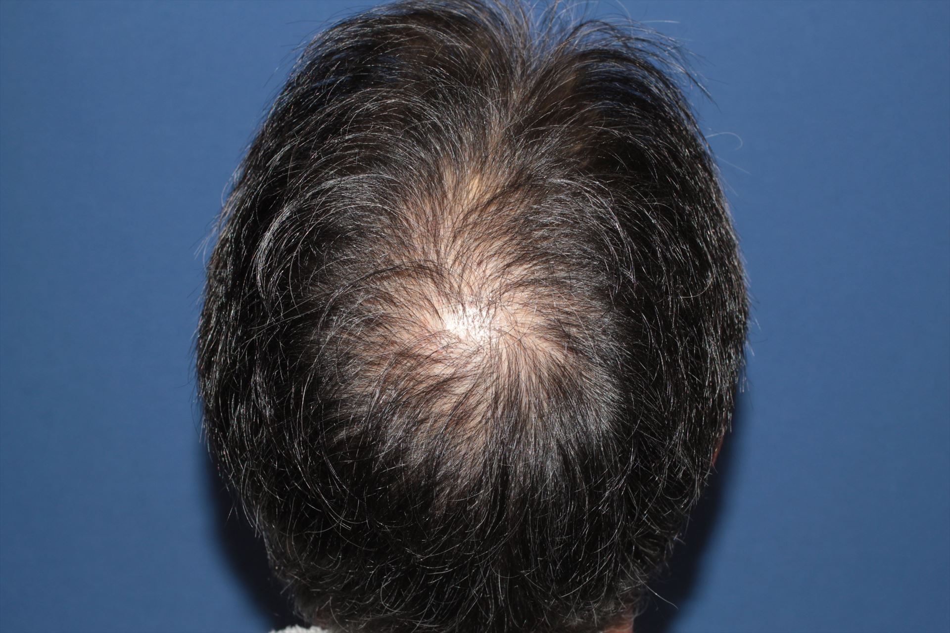 50代 男性 H.K.さん 頭頂部・つむじ 自毛植毛(MIRAI法)2,000株の症例|自毛植毛の症例(手術後)