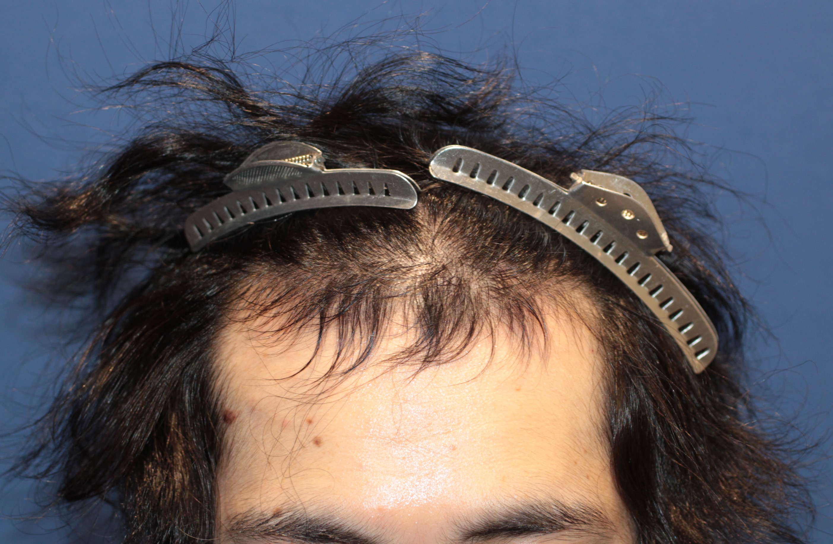 20代 男性 Y.O.さん 生え際 自毛植毛(MIRAI法)1,500株の症例|自毛植毛の症例(手術前)