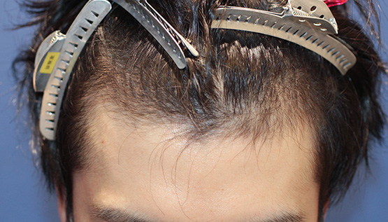 20代 男性 Y.N.さん 生え際 自毛植毛(MIRAI法)1,000株の症例|自毛植毛の症例(手術前)