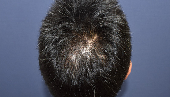 50代 男性 A.Y.さん 頭頂部 自毛植毛(MIRAI法)2,500株の症例|自毛植毛の症例(手術後)