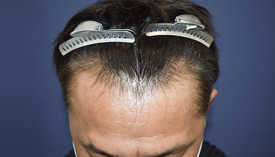 50代 男性 O.S.さん 生え際 自毛植毛(MIRAI法)1,000株の症例|自毛植毛の症例(手術前)