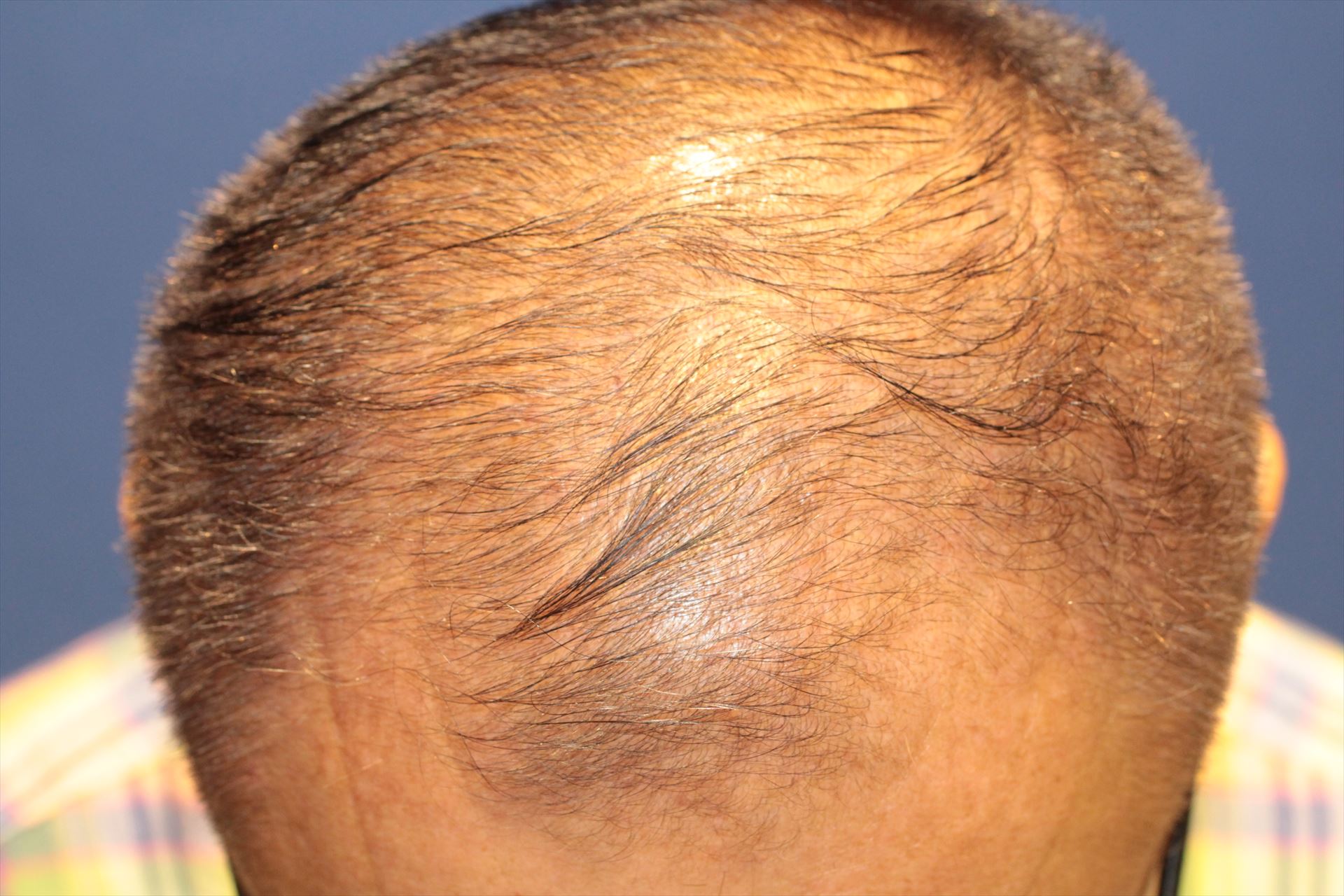 60代 男性 K.Y.さん 頭頂部 自毛植毛(MIRAI法)2,500株の症例|自毛植毛の症例(手術前)