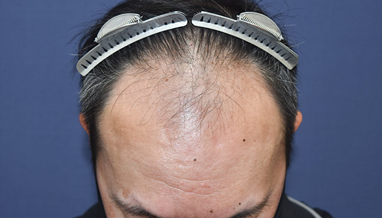 40代 男性 Y.K.さん 生え際・前頭部 自毛植毛(MIRAI法)3,000株の症例|自毛植毛の症例(手術前)