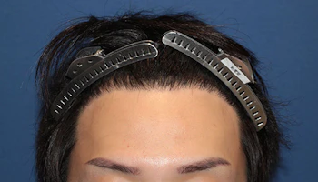 20代男性 施術後1年経過