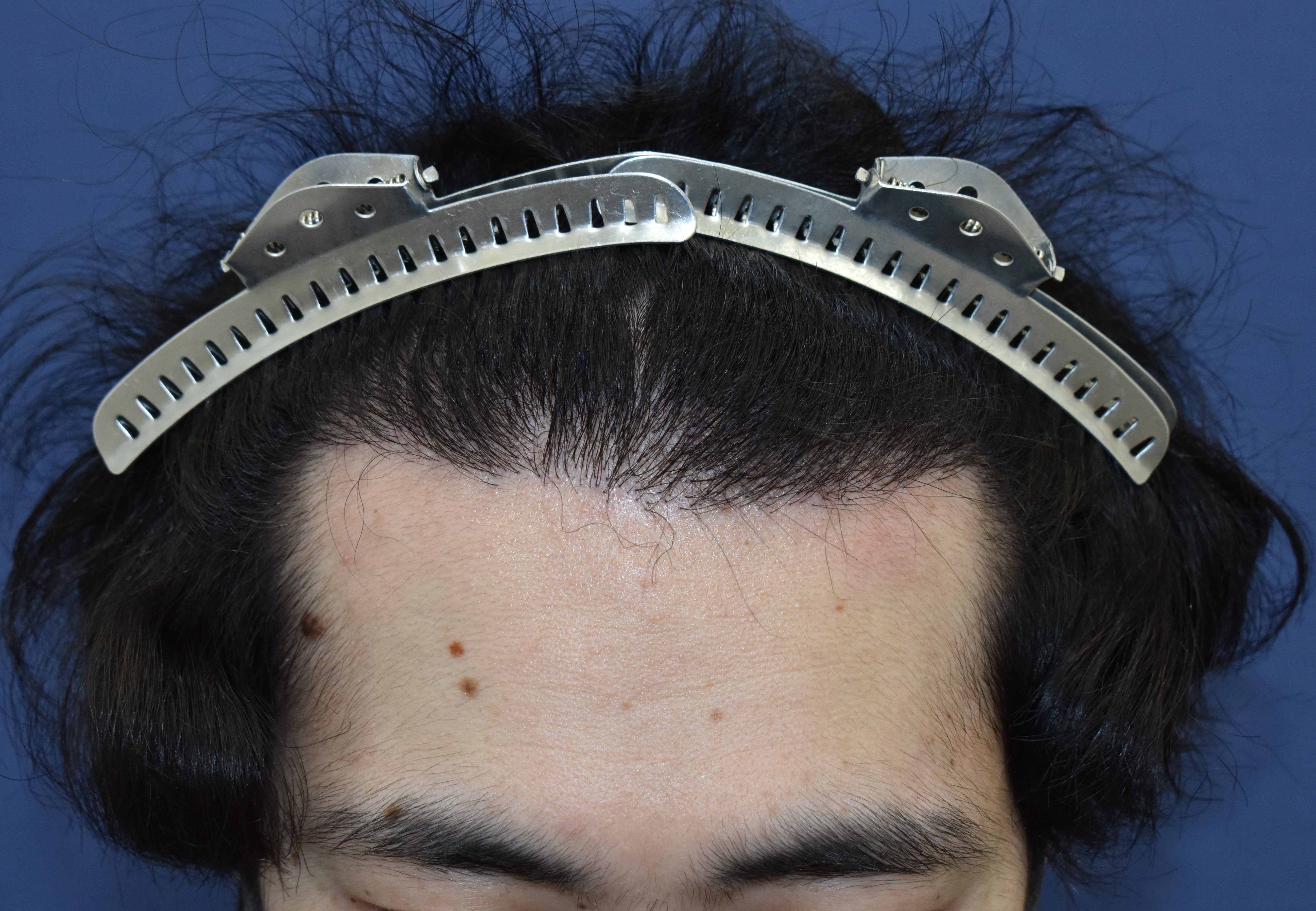 20代 男性 Y.O.さん 生え際 自毛植毛(MIRAI法)1,500株の症例|自毛植毛の症例(手術後)