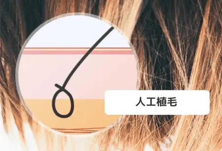 人工毛植毛の方が安い?