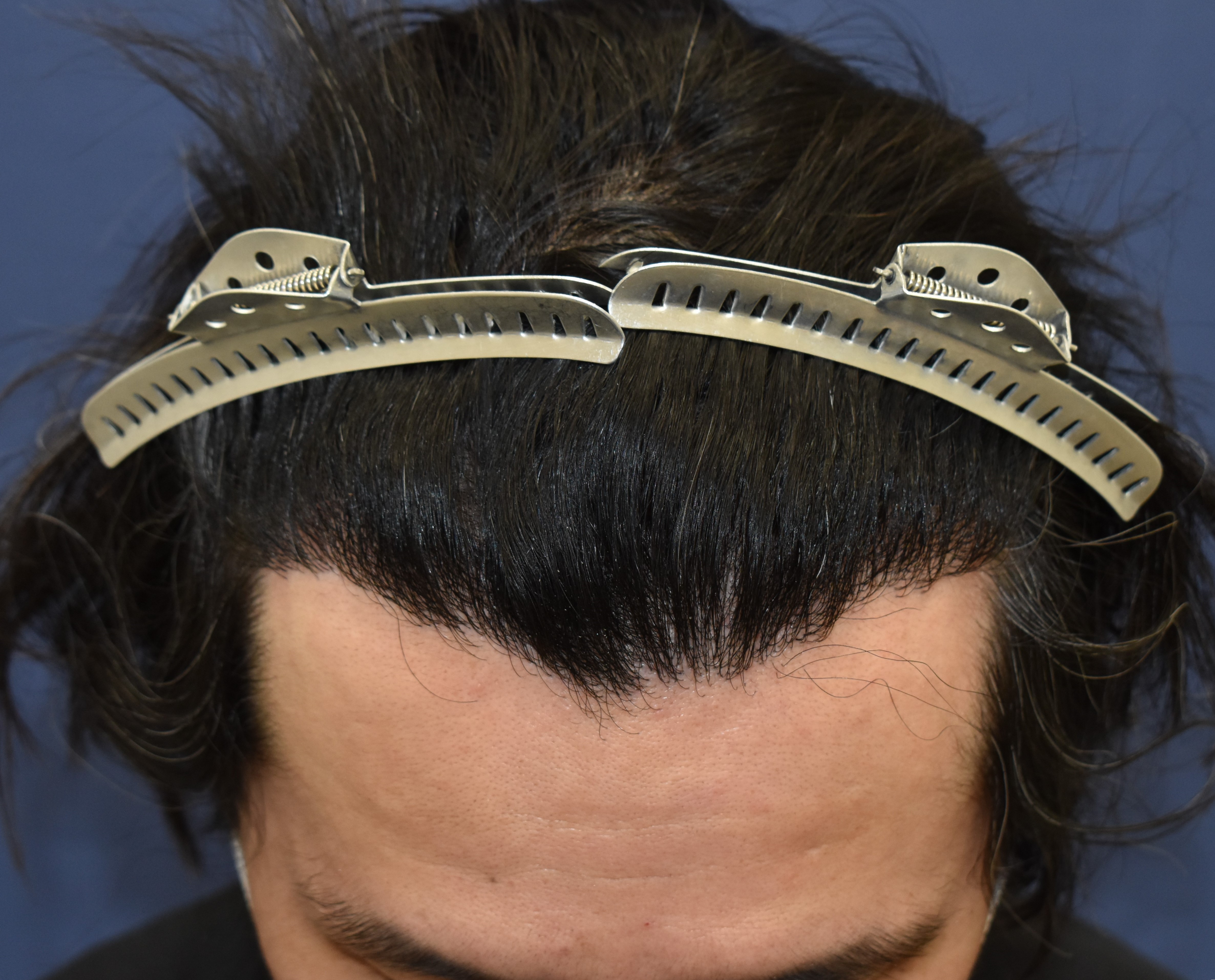 40代 男性 K.I.さん 生え際 前頭部 自毛植毛(MIRAI法)1,500株の症例|自毛植毛の症例(手術後)