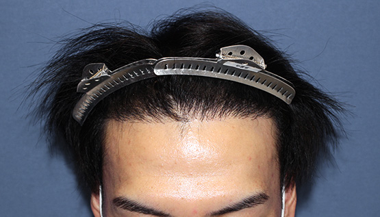 20代 男性 Y.B.さん 生え際・前頭部・頭頂部(MIRAI法)3,000株の症例|自毛植毛の症例(手術前)