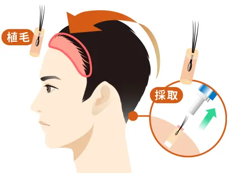 自毛植毛の仕組み