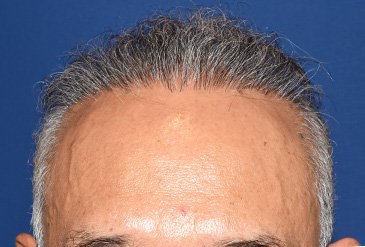 50代 男性 T.M.さん 生え際・前頭部 自毛植毛(MIRAI法)1,500株の症例|自毛植毛の症例(手術後)