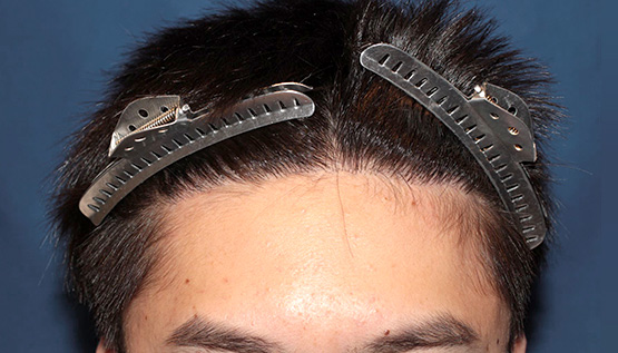 20代 男性 K.H.さん 生え際 自毛植毛(MIRAI法)700株の症例|自毛植毛の症例(手術後)