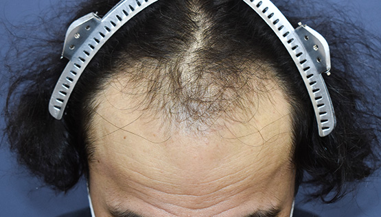 40代 男性 I.K.さん 生え際・前頭部 自毛植毛(MIRAI法)2,800株の症例|自毛植毛の症例(手術前)