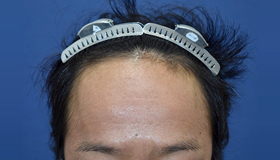 30代 男性 O.S.さん 生え際 自毛植毛(MIRAI法)1,500株の症例|自毛植毛の症例(手術前)