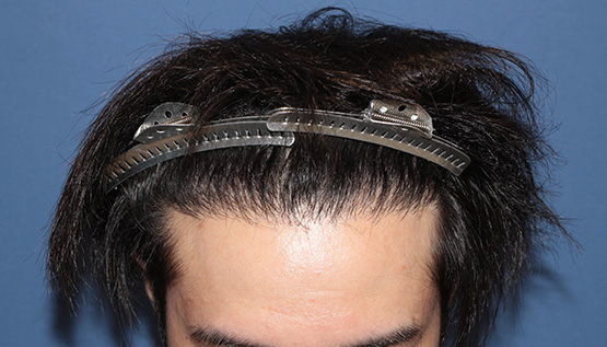 30代 男性 N.K.さん 生え際 自毛植毛(MIRAI法)1,200株の症例|自毛植毛の症例(手術後)