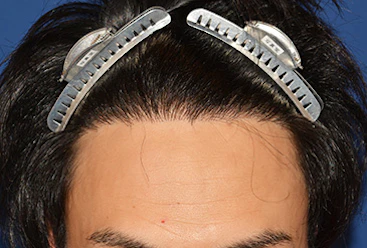 30代 男性 H.T.さん 生え際 自毛植毛(MIRAI法)1,500株の症例|自毛植毛の症例(手術後)