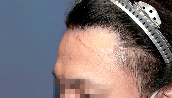 30代 男性 M.W.さん 生え際・瘢痕部 自毛植毛(MIRAI法)1,200株の症例|自毛植毛の症例(手術後)