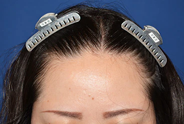 30代 女性 M.A.さん 生え際 自毛植毛(MIRAI法)450株の症例(手術前)