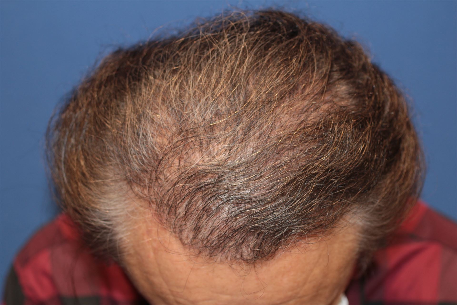 60代 男性 K.Y.さん 頭頂部 自毛植毛(MIRAI法)2,500株の症例|自毛植毛の症例(手術後)