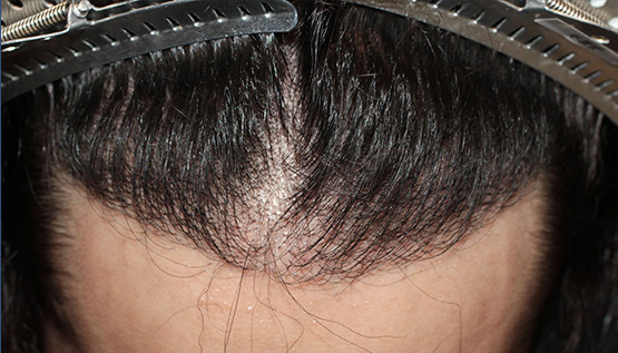 20代 男性 M.K.さん 生え際 自毛植毛(MIRAI法)1,500株の症例|自毛植毛の症例(手術後)