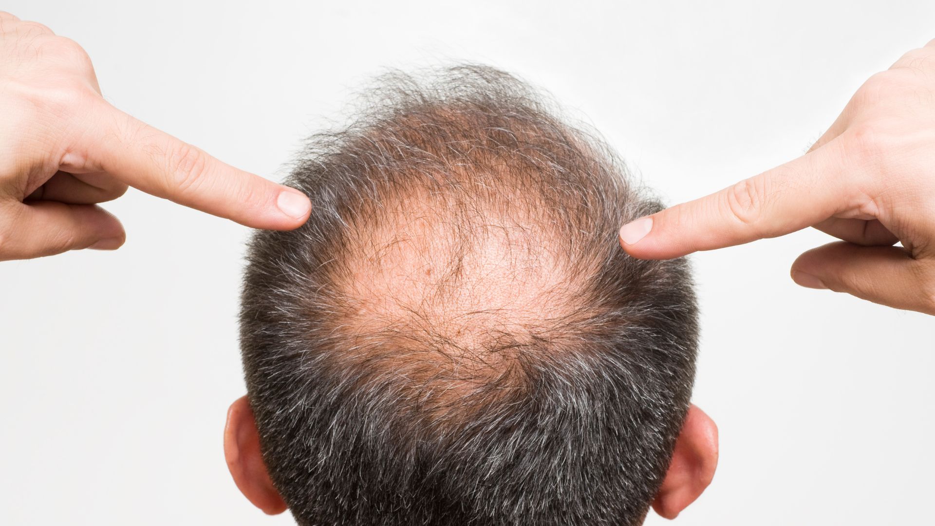 薄毛が広がる前に治療を始める