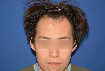 20代 男性 S.T.さん 生え際 自毛植毛(MIRAI法) 2,000株の症例|自毛植毛の症例(手術前)