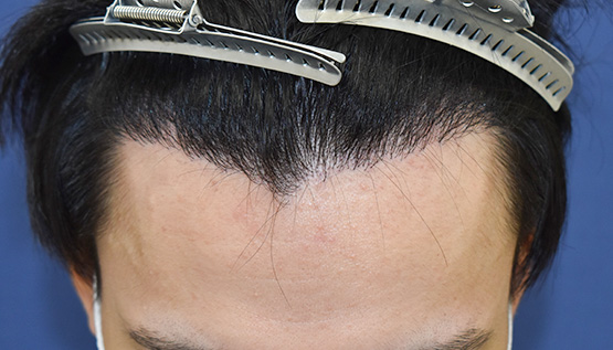 20代 男性 Y.U.さん 生え際 自毛植毛(MIRAI法)1,200株の症例|自毛植毛の症例(手術後)