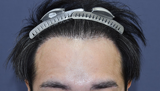 30代 男性 K.T.さん 生え際・頭頂部・つむじ 自毛植毛(MIRAI法)3,000株の症例|自毛植毛の症例(手術後)