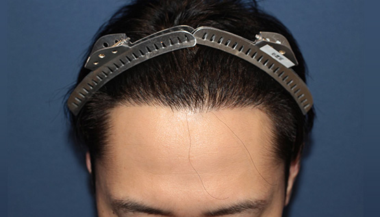 30代 男性 H.H.さん 生え際 自毛植毛(MIRAI法)1,500株の症例|自毛植毛の症例(手術後)