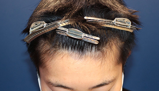 20代 男性 K.S.さん 生え際 自毛植毛(MIRAI法)800株の症例|自毛植毛の症例(手術前)