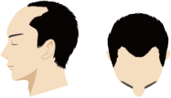 1000株(グラフト)以上の自毛植毛の場合