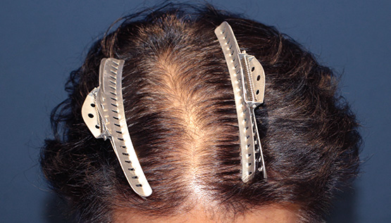 50代 男性 T.U.さん 前頭部 自毛植毛(MIRAI法)2,000株の症例|自毛植毛の症例(手術前)